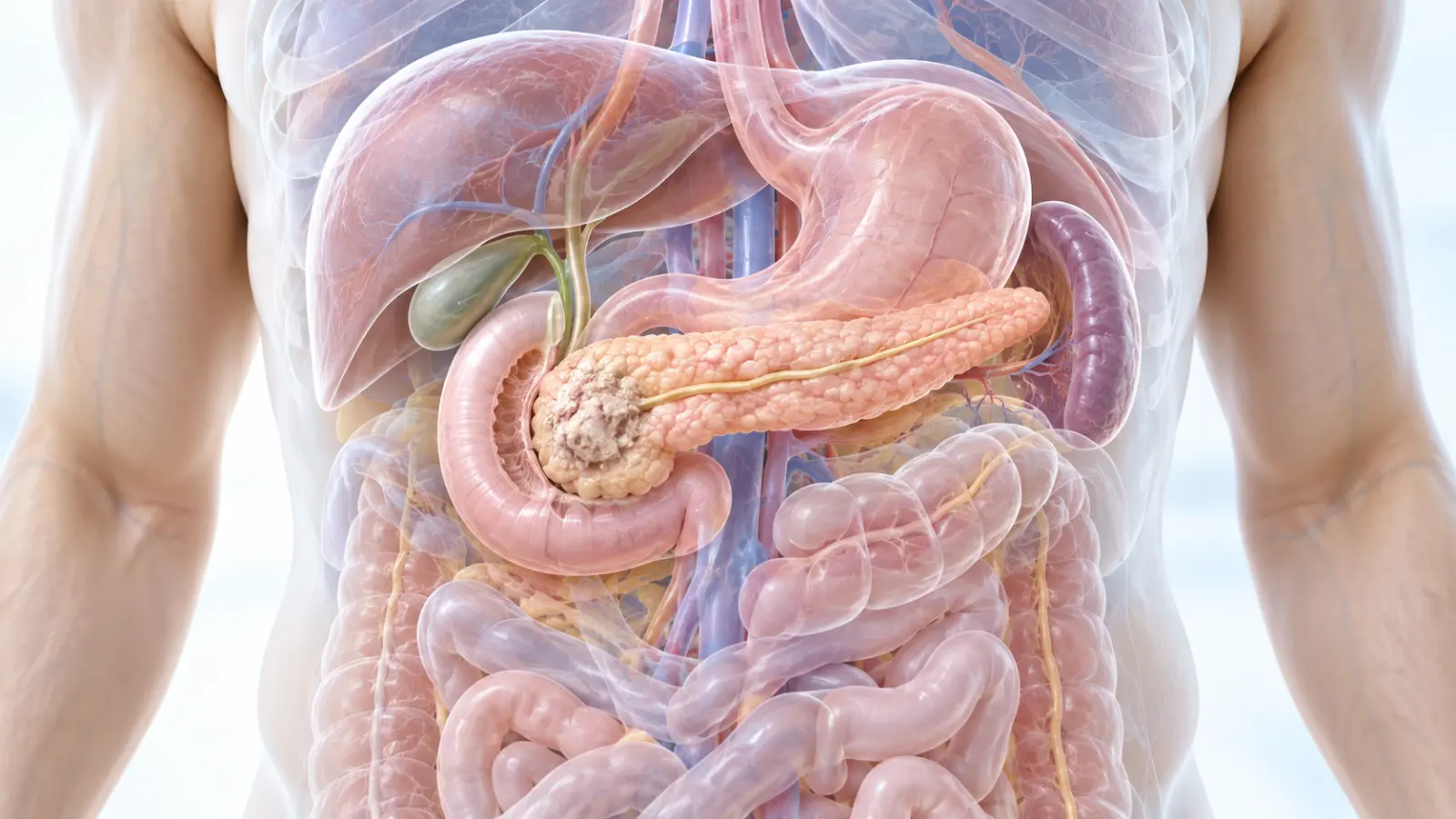 มะเร็งตับอ่อน(Pancreatic Ductal Adenocarcinoma)และ EUS
